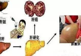肝硬化治疗方法,肝硬化综合治疗策略与最新进展